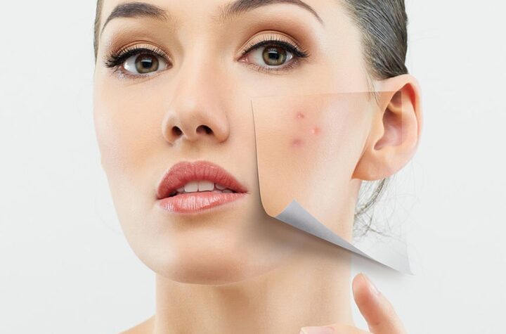 Which is better for clearing acne?