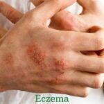 stress eczema