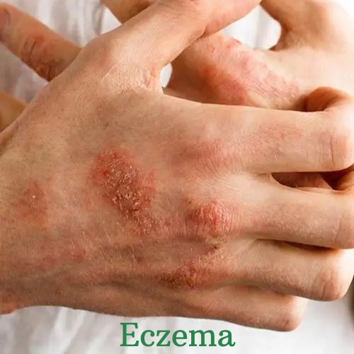 stress eczema